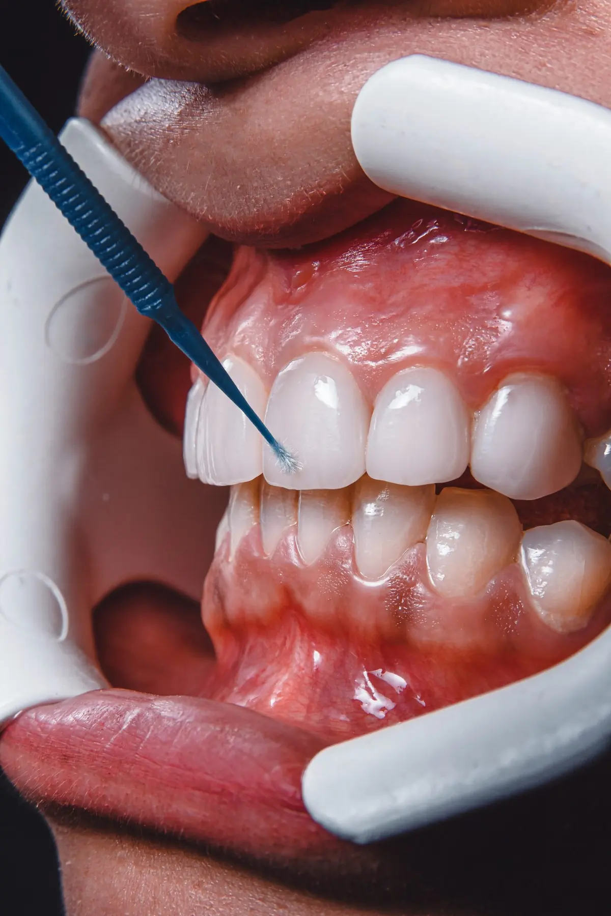 Sesión de higiene dental en la clínica